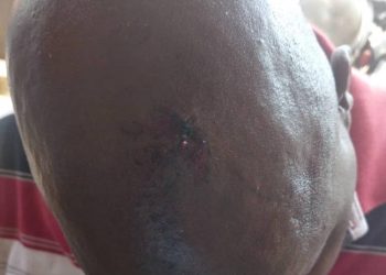 Exclusive Pictures: Juma Seiko’s Head shattered, Admitted to Mayo Clinic