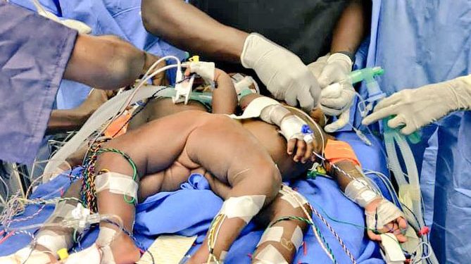 Mulago specialists separate Siamese Twins in 20-hour operation