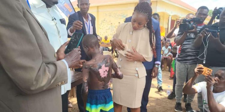 After donating Ambulance to Butebo, Keddi Foundation takes over Surgery and Education of Boy burnt by his Father