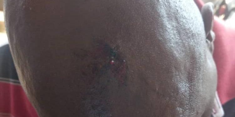 Exclusive Pictures: Juma Seiko’s Head shattered, Admitted to Mayo Clinic