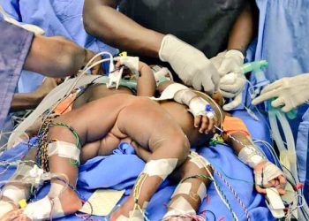 Mulago specialists separate Siamese Twins in 20-hour operation