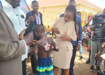 After donating Ambulance to Butebo, Keddi Foundation takes over Surgery and Education of Boy burnt by his Father